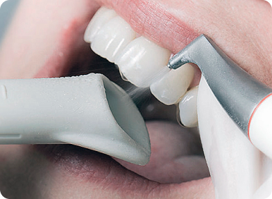 Ultranhagos fogkőeltávolítás - Forest & Ray Dental