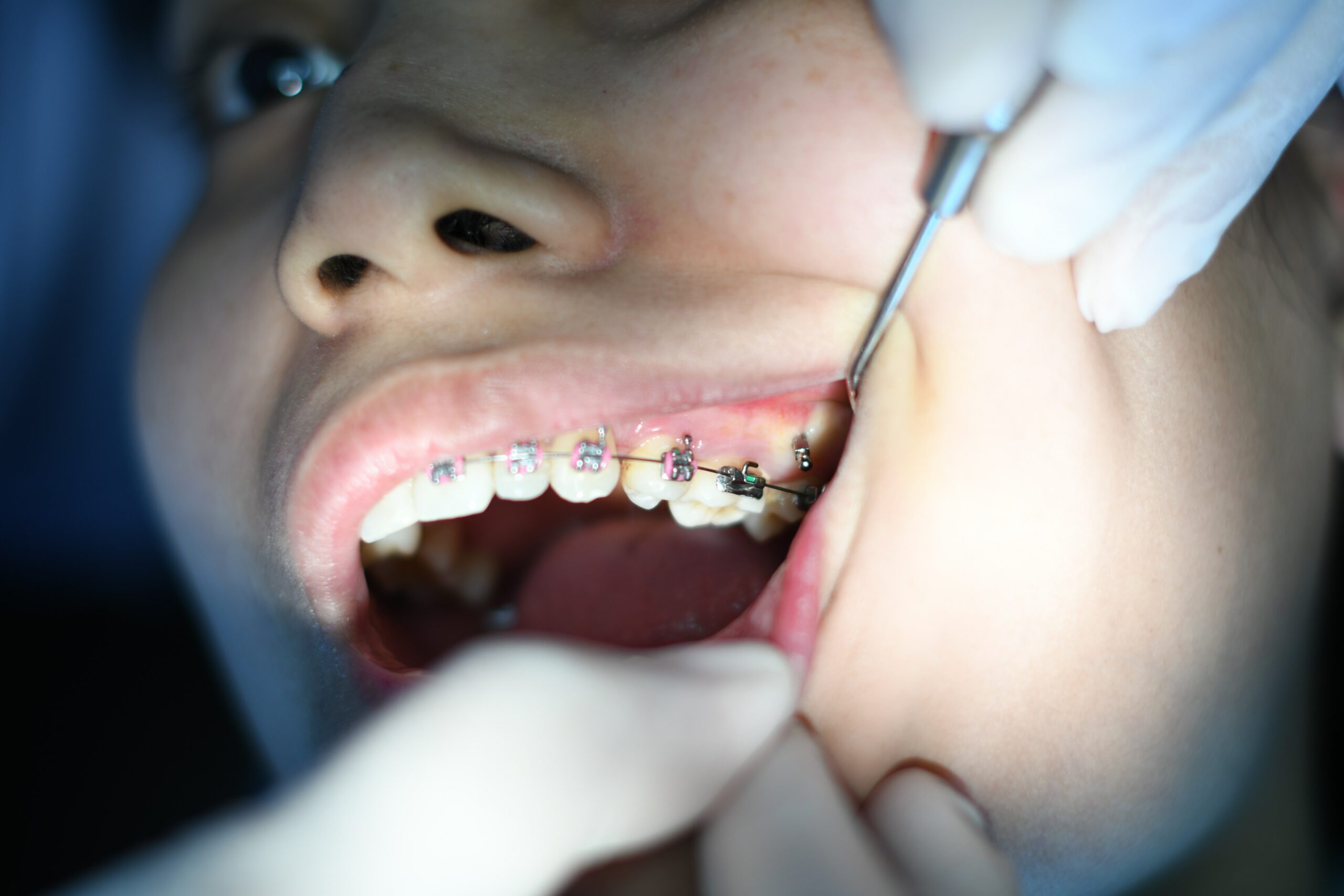 Felnőtt fogszabályozás az FR Dental