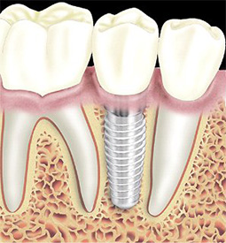 Fogászati implantátum - Forest&Ray Dental
