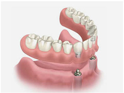 Fogászati implantátummal rögzített fogsor - Fores&Ray Dental