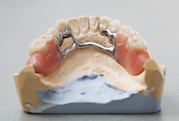 A fogpótlás fajtái: kombinált fogpótlás - Forest&Ray Dental