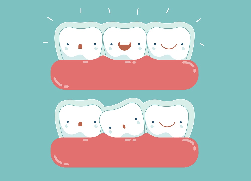 Láthatatlan fogszabályozás, felnőtt fogszabályozás - Forest&Ray Dental