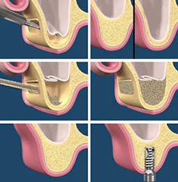 Arcüreg emelés fogászati implantációhoz - Forest&Ray Dental