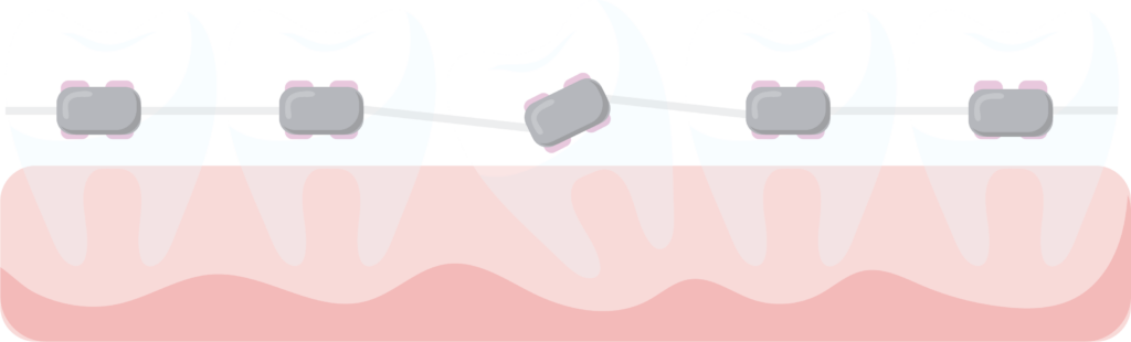 Gyerek fogszabályozás, felnőtt fogszabályozás és láthatatlan fogszabályozás - FR Dental