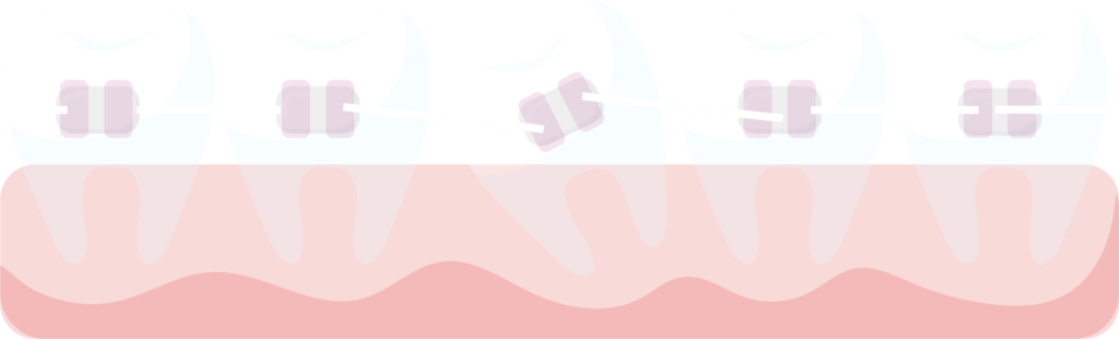 Gyerek fogszabályozás, felnőtt fogszabályozás és láthatatlan fogszabályozás - FR Dental