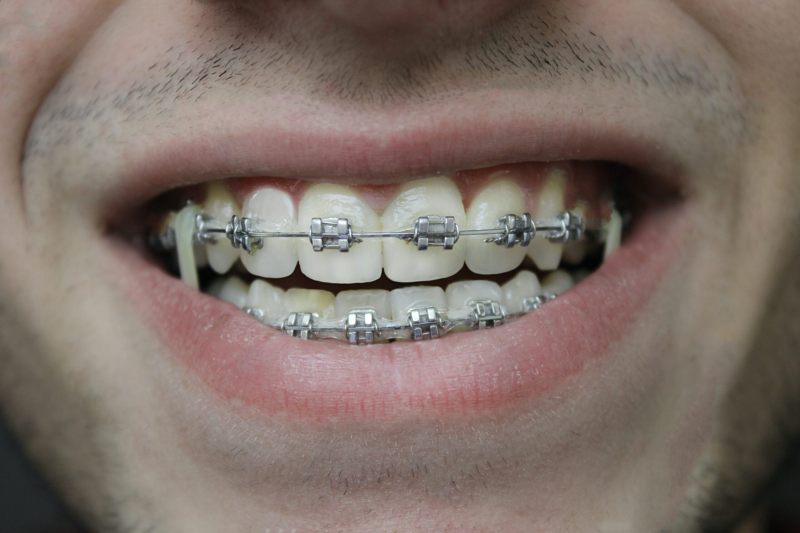 Adult orthodontics Budapest